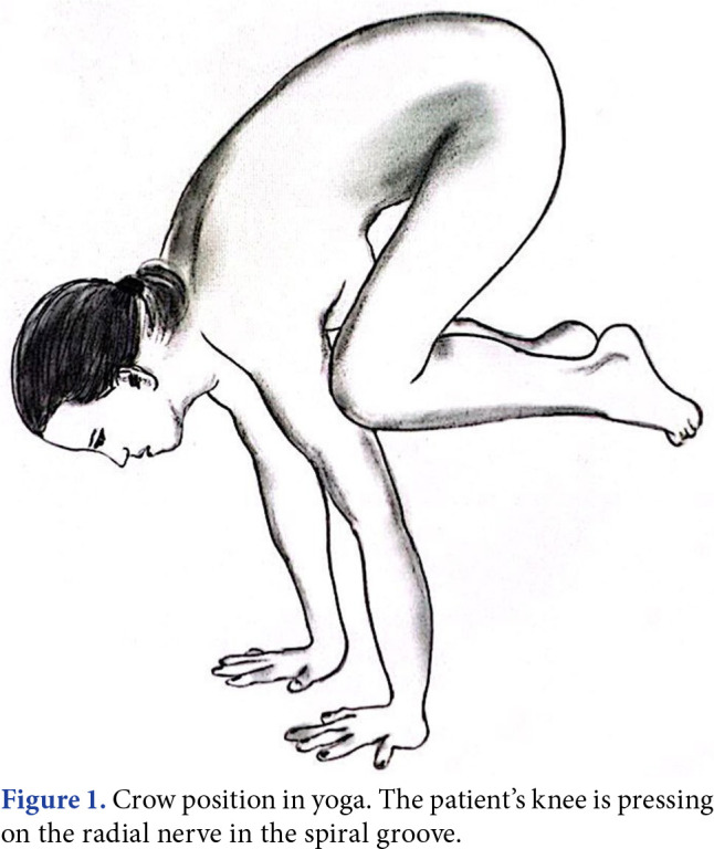 An interesting cause of wrist drop: The crow position in yoga and hereditary neuropathy with liability to pressure palsies.