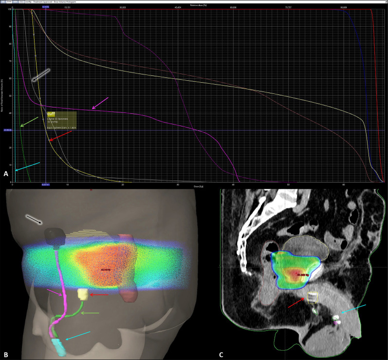 Optimizing functional outcomes in prostate cancer: a new perspective on early artificial urinary sphincter implantation before salvage radiotherapy in prostate cancer treatment.