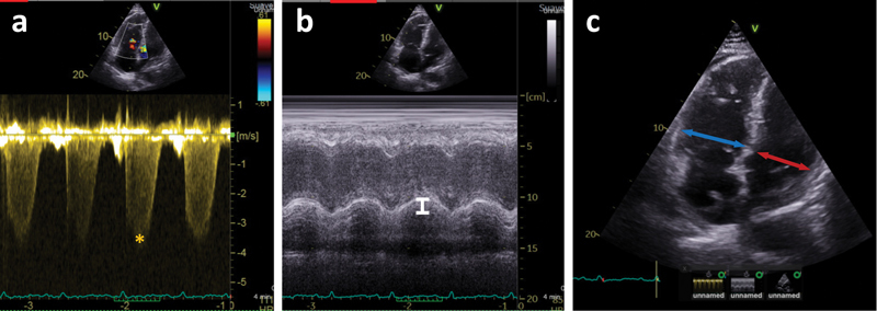 Validation of Echocardiographic Measurements in Patients with Pulmonary Embolism in the RIETE Registry.