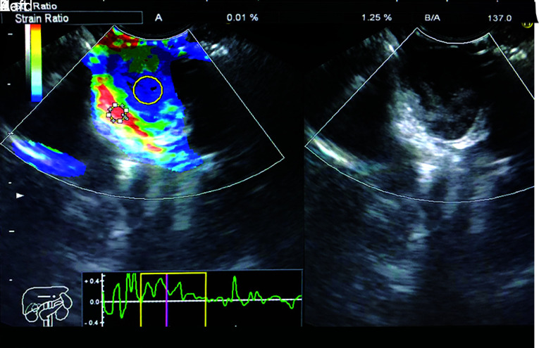 Use of Endoscopic Ultrasound Elastography to Differentiate between Gastrointestinal Stromal Tumor and Leiomyoma Localized in the Upper Gastrointestinal Tract.