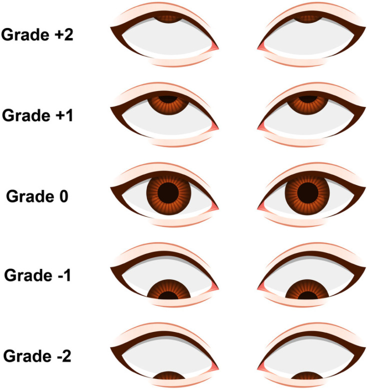 Ocular surface lesions in clinical grades of Bell's phenomenon.