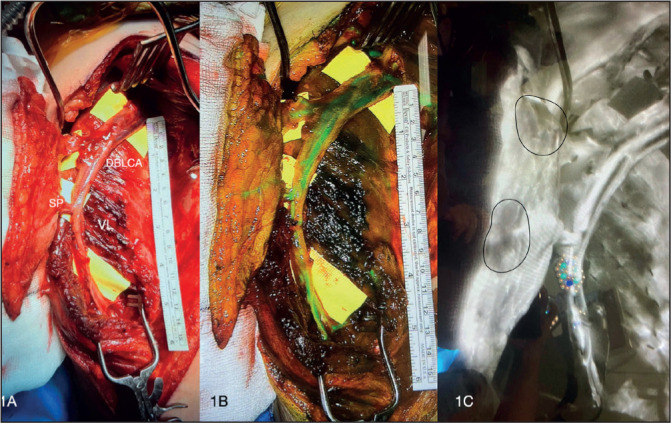A GAME-CHANGER IN FREE-TISSUE SURGERY: THE FUTURE'S BRIGHT, THE FUTURE'S FLUORESCENT….