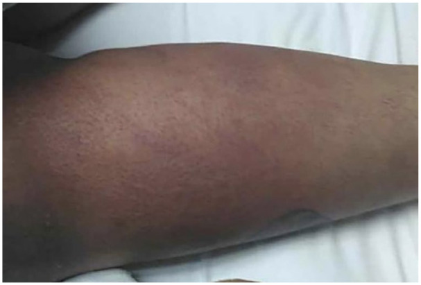 A Rare Case of Anti-TIF-1γ Antibody Positive Dermatomyositis in Adulthood.