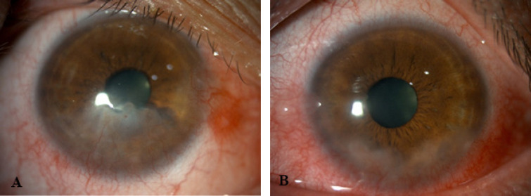 Ocular surface lesions in clinical grades of Bell's phenomenon.