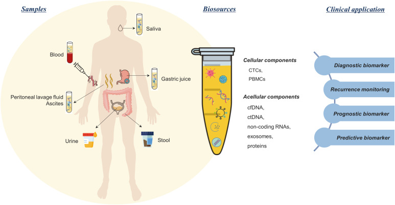 Liquid Biopsy: An Emerging Diagnostic, Prognostic, and Predictive Tool in Gastric Cancer.