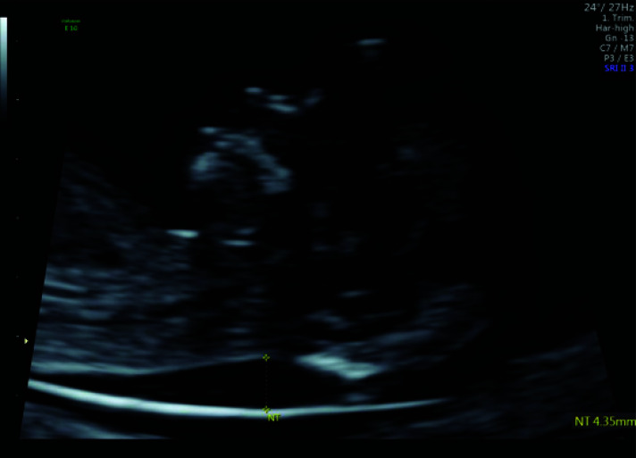 Nuchal Translucency and Congenital Heart Defects.