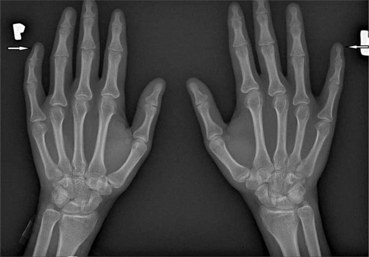 Musculoskeletal involvement in systemic sclerosis.