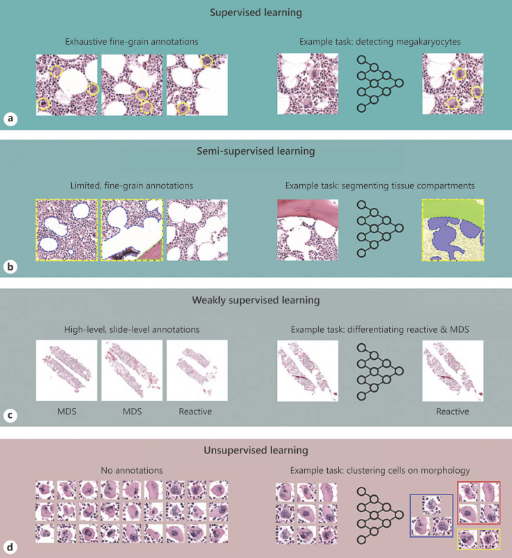 Artificial Intelligence in Bone Marrow Histological Diagnostics: Potential Applications and Challenges.