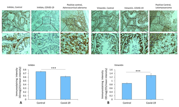 Vimentin as a contributing factor in SARS-CoV-2-induced orchitis on postmortem testicular autopsy of COVID-19 cases: A case-control study.