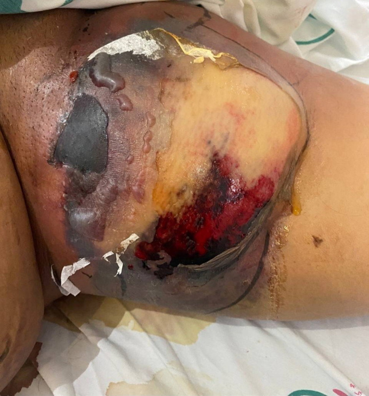 Post-procedural necrotizing fasciitis following femoral coronary angiography in patient with chronic endocarditis: A case report.