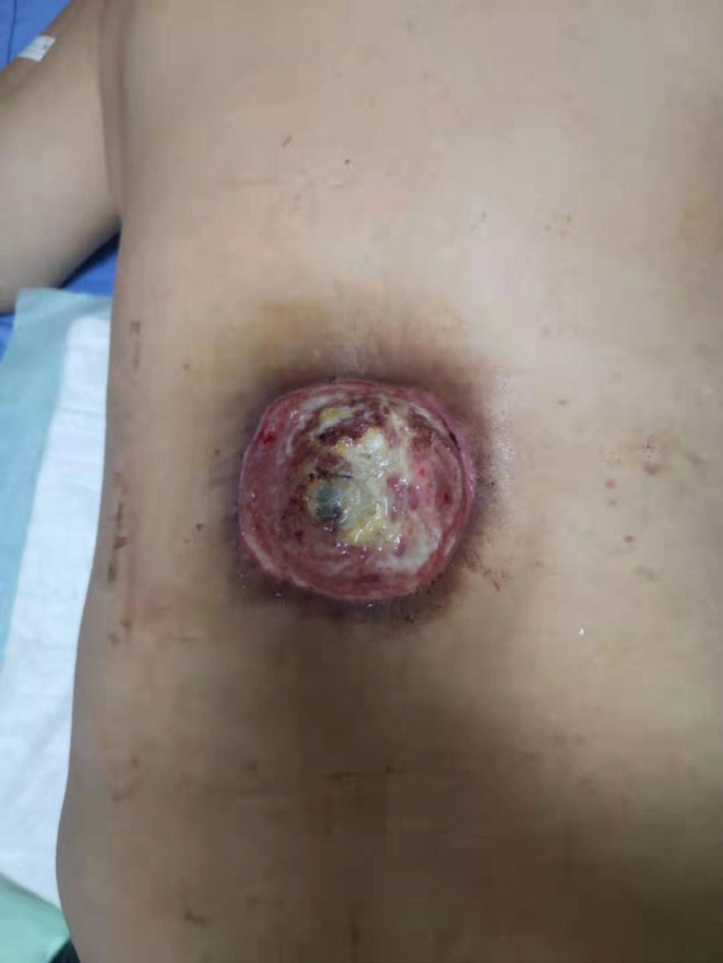 Reverse Turnover Pedicled Latissimus Dorsi Muscle Flap for the Repair of Radiation Ulcer in the Back: A Case Report.
