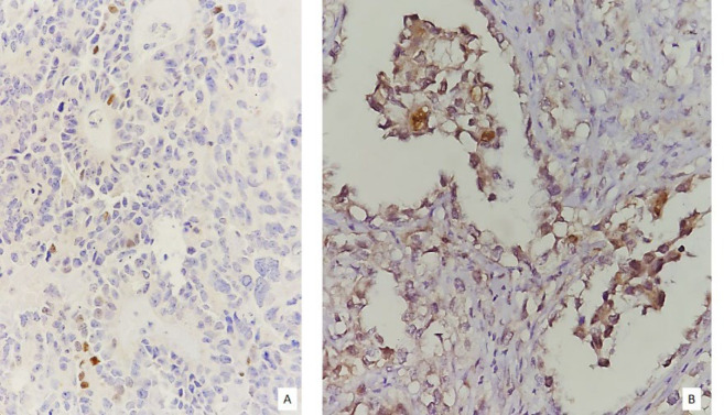 Prevalence and Pattern of GATA3 Immunohistochemical Expression in Female Genital Tract Adenocarcinomas.