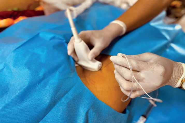 Ultrasound-guided Femoral - Sciatic Nerve Block for Lower Limb Long Bone Fractures.