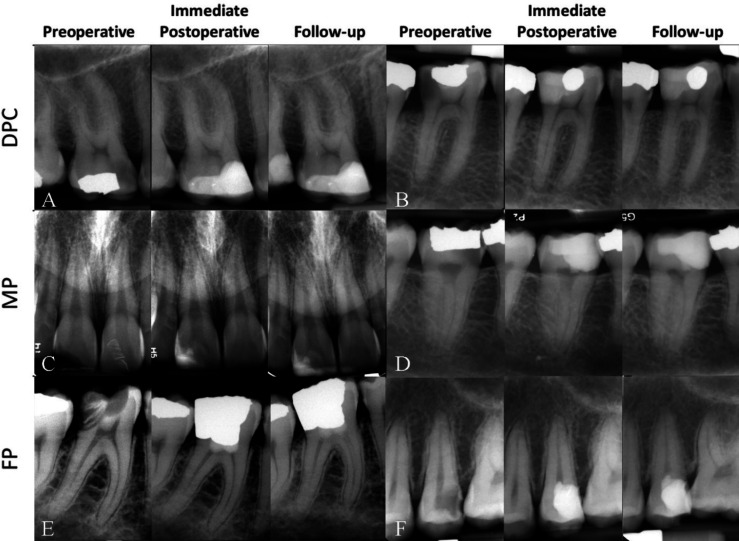Apical Periodontitis in Vital and Nonvital Teeth: Clinical and Radiographic Features.
