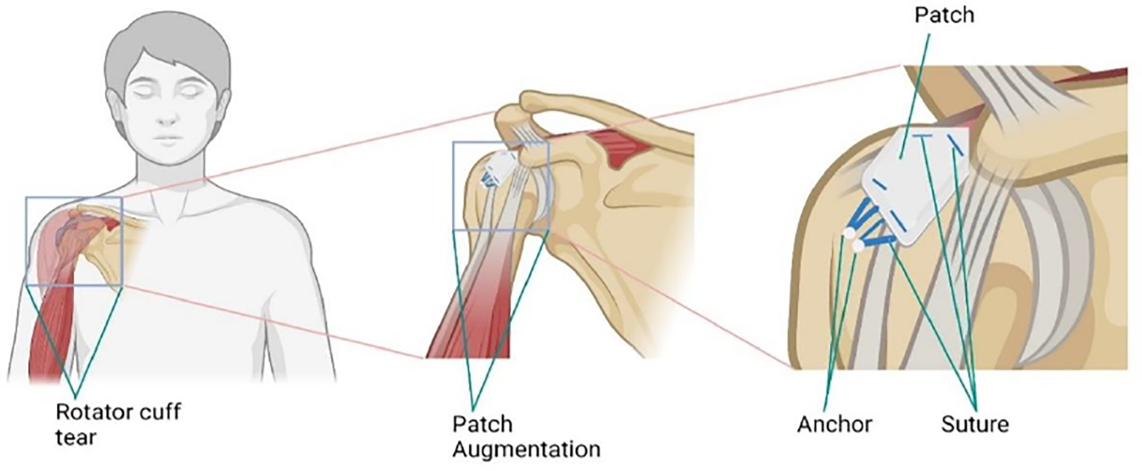 Biologically Enhanced Patch in the Healing and Mechanical Stability of Rotator Cuff Tears.