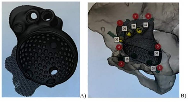 Does the interface between individual 3D acetabular implants and host bone influence the functional outcomes in patients with severe bone loss after revision surgery?