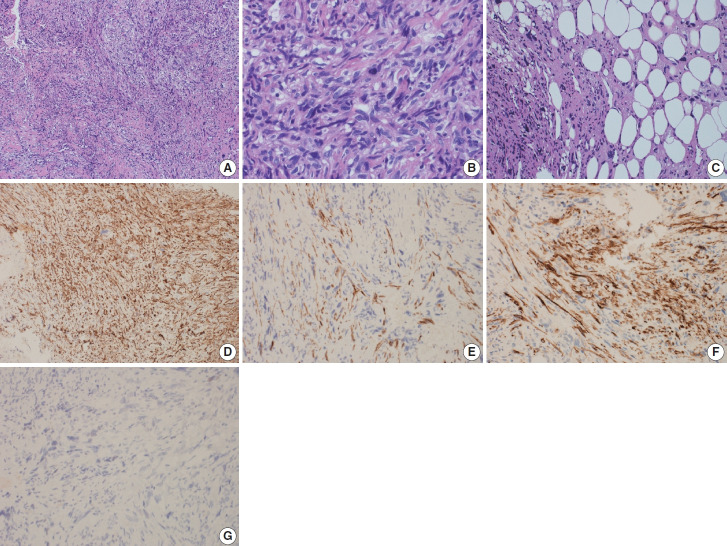 Primary leiomyosarcoma of the bone: a case report.