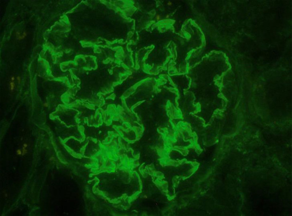 A case report of atypical anti-glomerular basement membrane nephritis associated with Mycobacterium Avium.