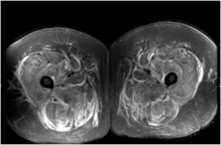 A Rare Case of Anti-TIF-1γ Antibody Positive Dermatomyositis in Adulthood.