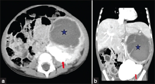 Association of Wilms Tumor with Crossed Fused Renal Ectopia in Children: A Case Report.