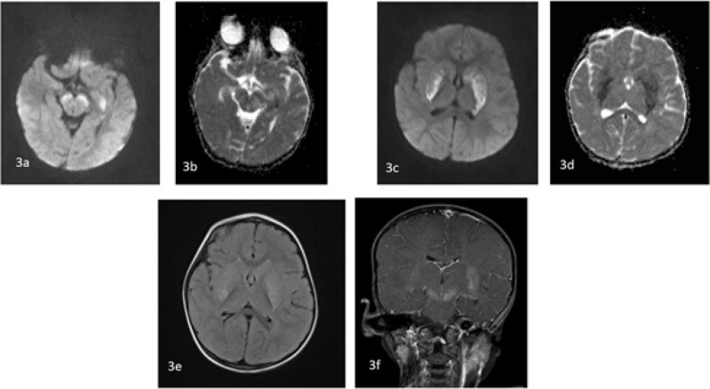 COVID-19-Associated Neurological Complications in Children.