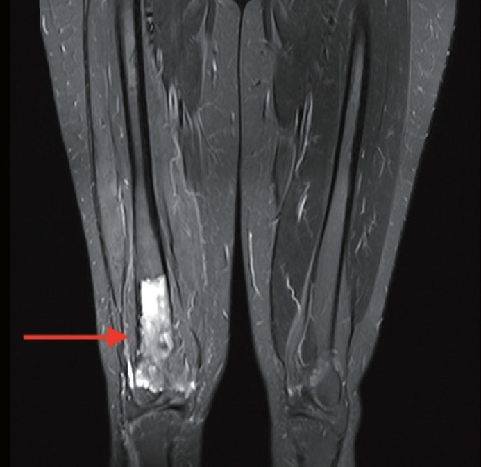 Primary leiomyosarcoma of the bone: a case report.