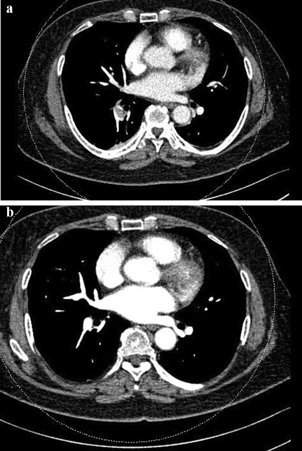 Efficacy of pulse oximetry for early diagnosis of pulmonary embolism after total knee arthroplasty.