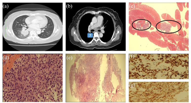 Early experience of endobronchial ultrasound-guided transbronchial nodal cryobiopsy: a case series from Sabah, Malaysia.