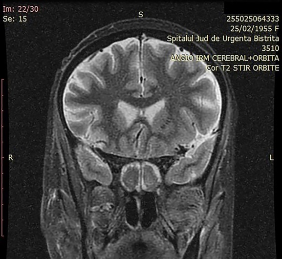 Magnetic Resonance Imaging in COVID-19 Associated Rhino-Sinusal Mucormycosis.