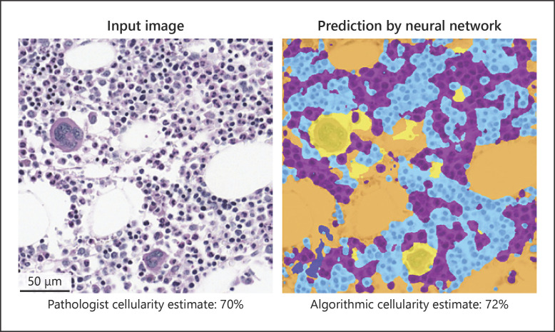 Artificial Intelligence in Bone Marrow Histological Diagnostics: Potential Applications and Challenges.