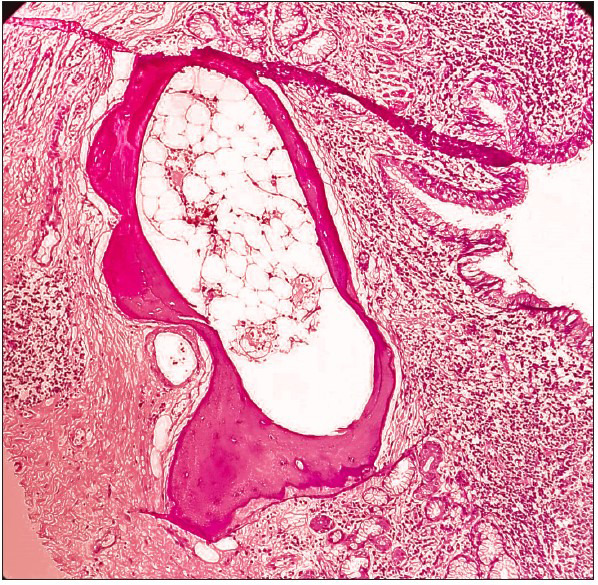 Bronchiectatic Actinomycosis with Osseous Metaplasia Masquerading as Lung Cancer.