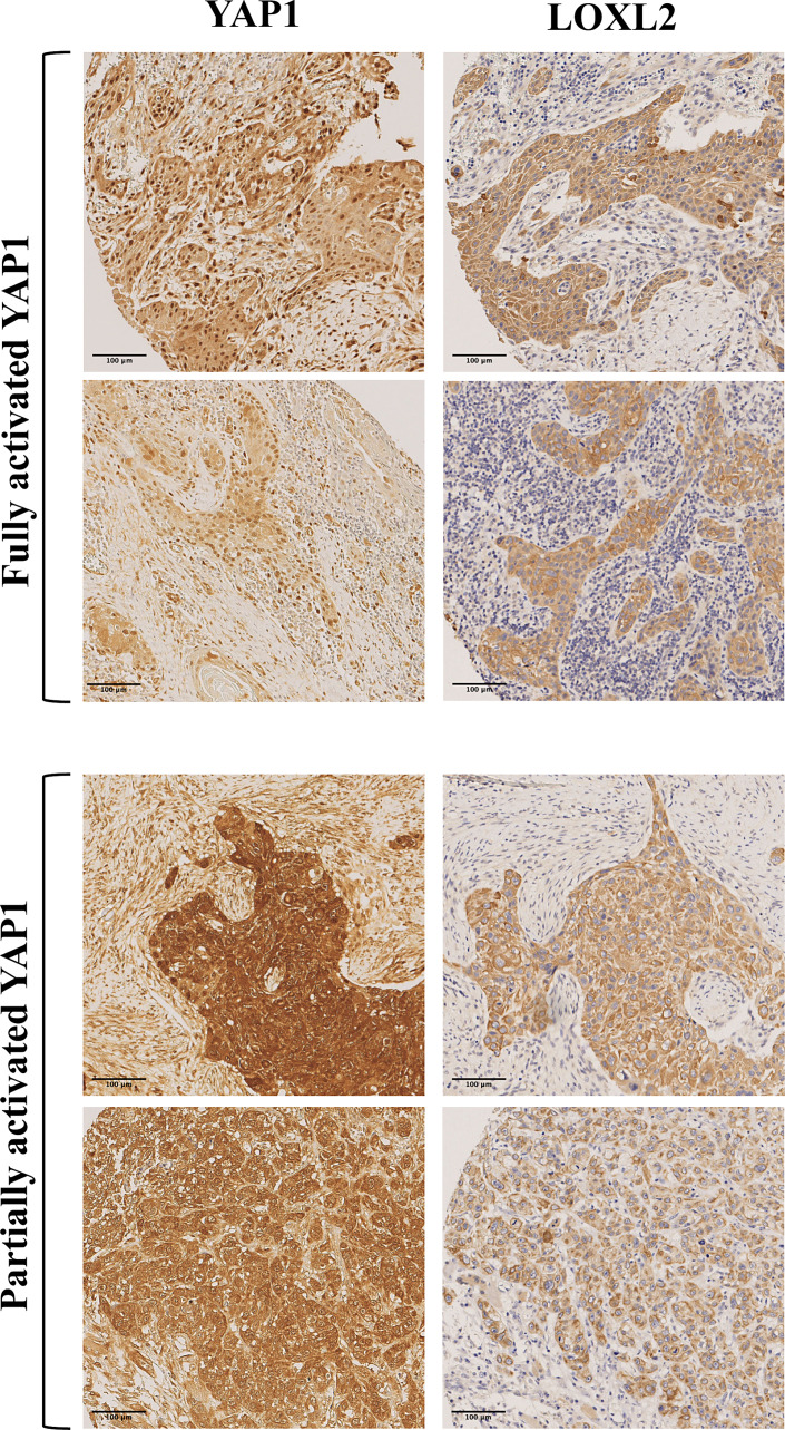 Tumor-Intrinsic Perinuclear LOXL2: Prognostic Relevance and Relationship with YAP1 Activation Status in Oral Squamous Cell Carcinoma.
