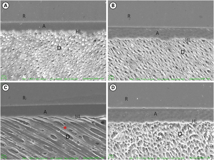 Pomegranate extract on eroded dentin: antioxidant action, bond strength and morphology of the adhesive interface after aging.