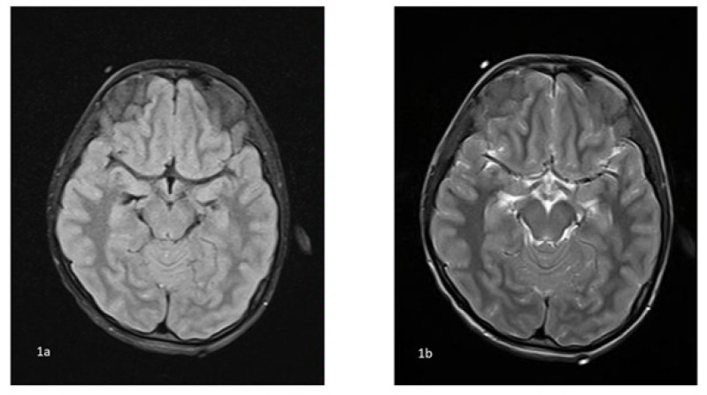 COVID-19-Associated Neurological Complications in Children.