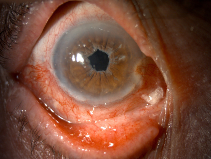 Ocular surface lesions in clinical grades of Bell's phenomenon.