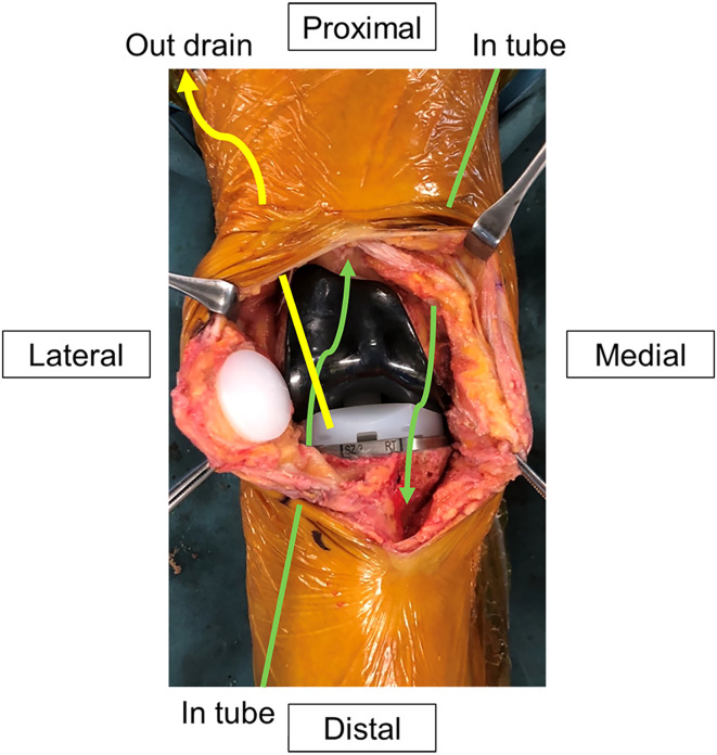 High-concentration continuous local antibacterial perfusion therapy: safety and potential efficacy for acute and chronic periprosthetic knee joint infection.