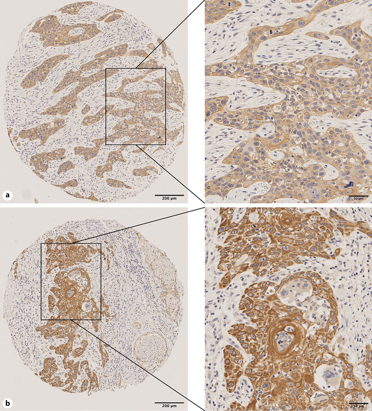 Tumor-Intrinsic Perinuclear LOXL2: Prognostic Relevance and Relationship with YAP1 Activation Status in Oral Squamous Cell Carcinoma.