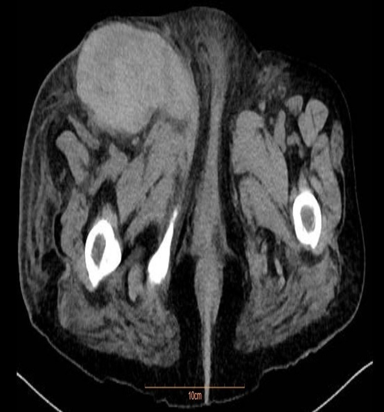 Post-procedural necrotizing fasciitis following femoral coronary angiography in patient with chronic endocarditis: A case report.