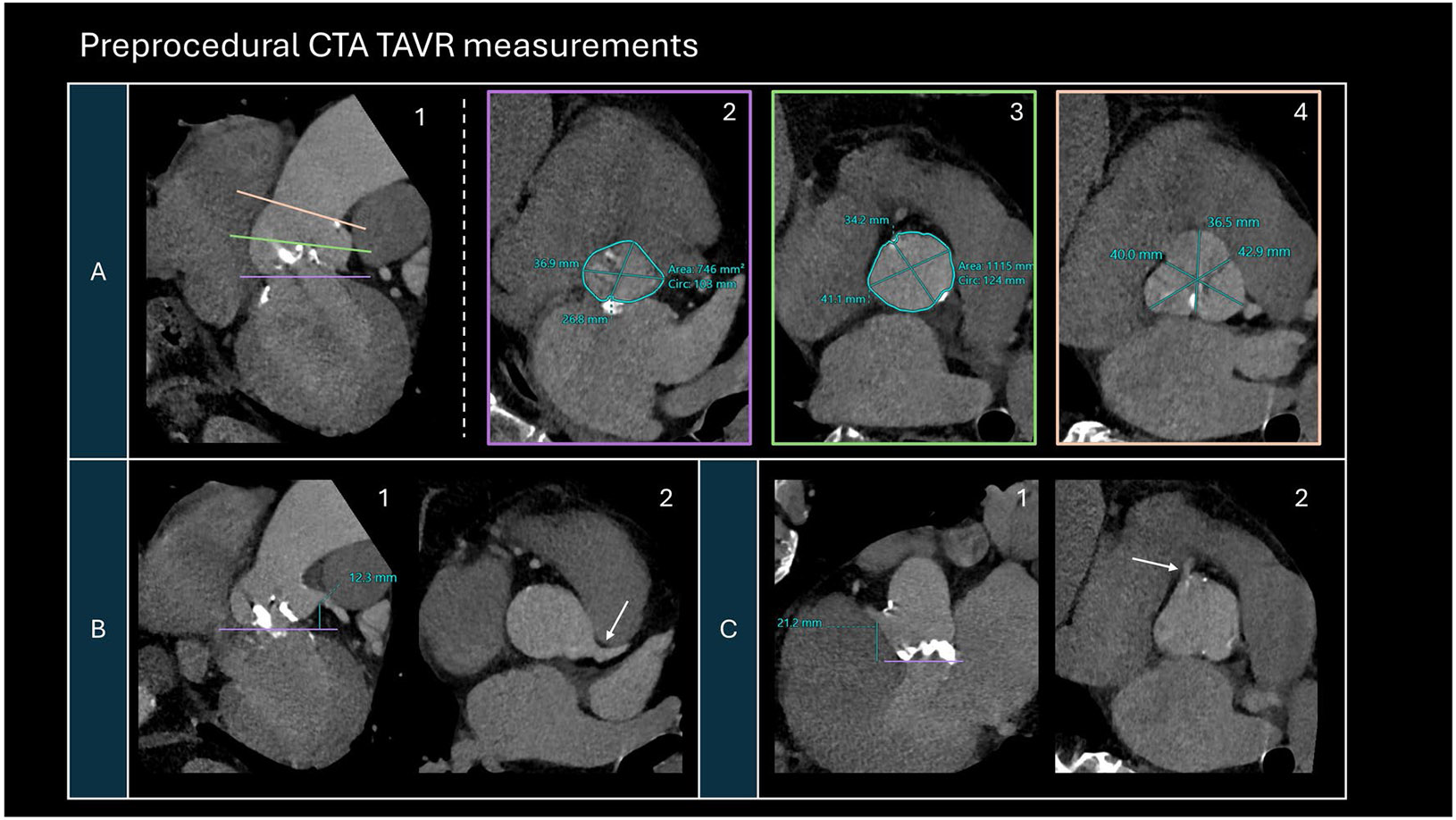 The Current Landscape of Artificial Intelligence in Imaging for Transcatheter Aortic Valve Replacement.