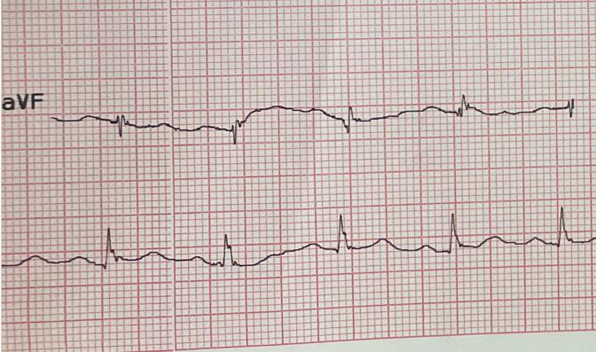 The utility of fragmented QRS in association with strain echocardiography in predicting significant coronary artery stenosis.