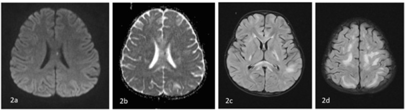 COVID-19-Associated Neurological Complications in Children.
