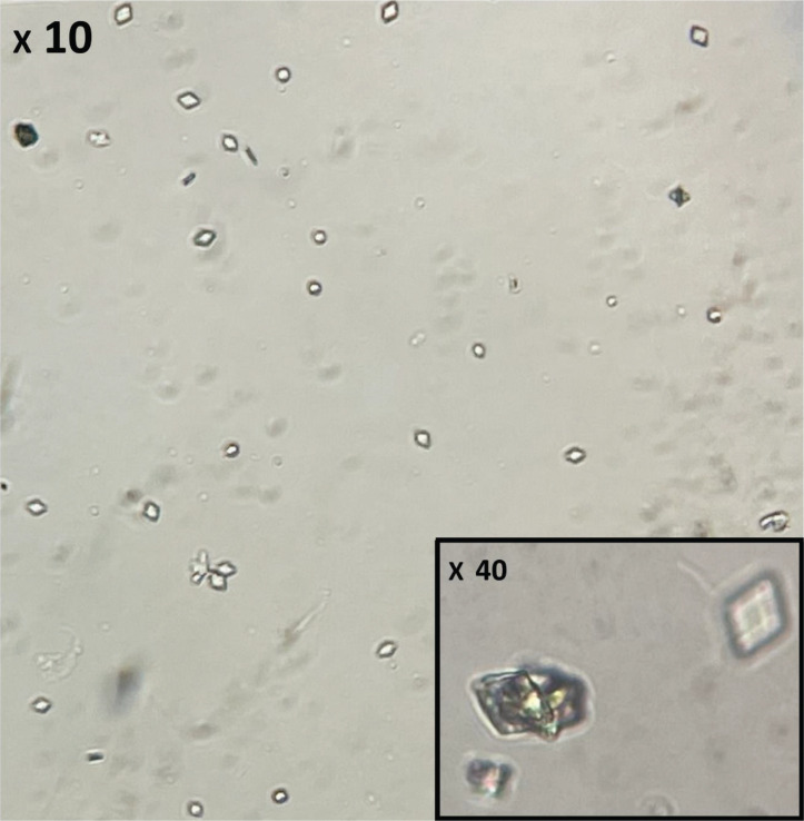 Uric Acid Crystalluria following the Recovery Phase of Diabetic Ketoacidosis (DKA): A Lesser-known Complication of DKA.