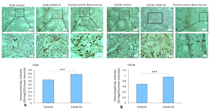 Vimentin as a contributing factor in SARS-CoV-2-induced orchitis on postmortem testicular autopsy of COVID-19 cases: A case-control study.