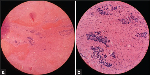 Association of Wilms Tumor with Crossed Fused Renal Ectopia in Children: A Case Report.