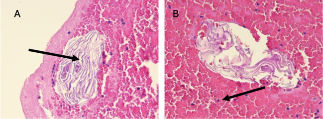 Cardiac Arrest Caused by Amniotic Fluid Embolism: a Report of Two Clinical Cases.