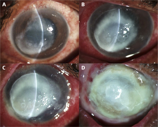 <i>Pythium insidiosum</i>: the organism that mimics fungal keratitis.