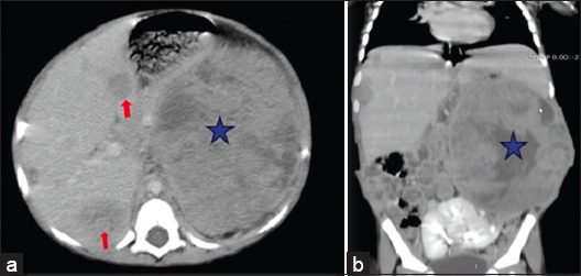 Association of Wilms Tumor with Crossed Fused Renal Ectopia in Children: A Case Report.