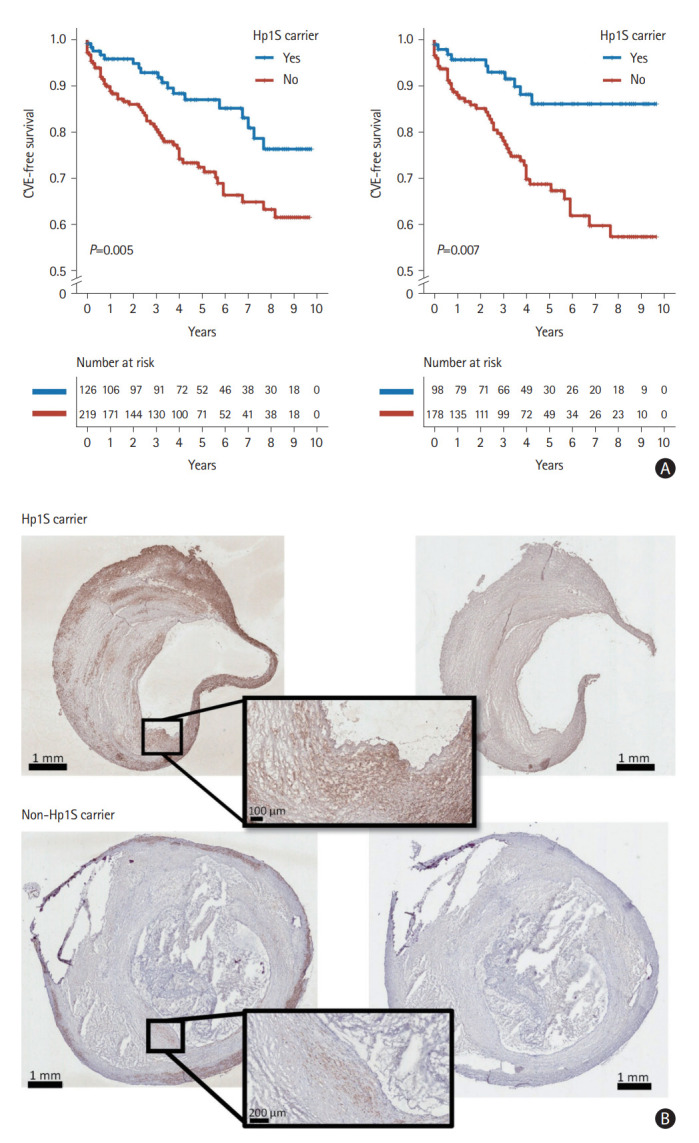 Haptoglobin Gene Polymorphism Is Associated With Lower Postoperative Cardiovascular Risk in Carotid Stenosis Patients.