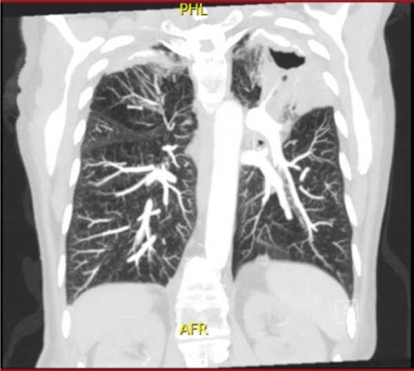 A case report of atypical anti-glomerular basement membrane nephritis associated with Mycobacterium Avium.