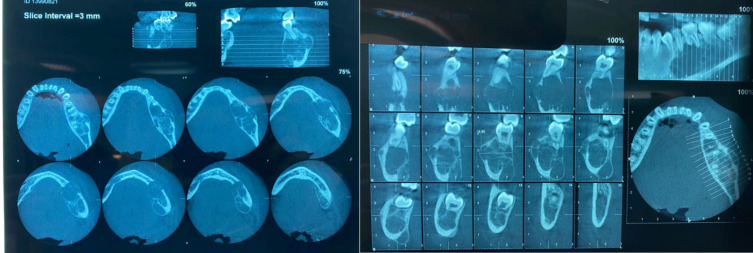 Successful Combined Treatment Approach for Central Giant Cell Granuloma: A Case Study of Surgery Following Intralesional Steroid Injection.